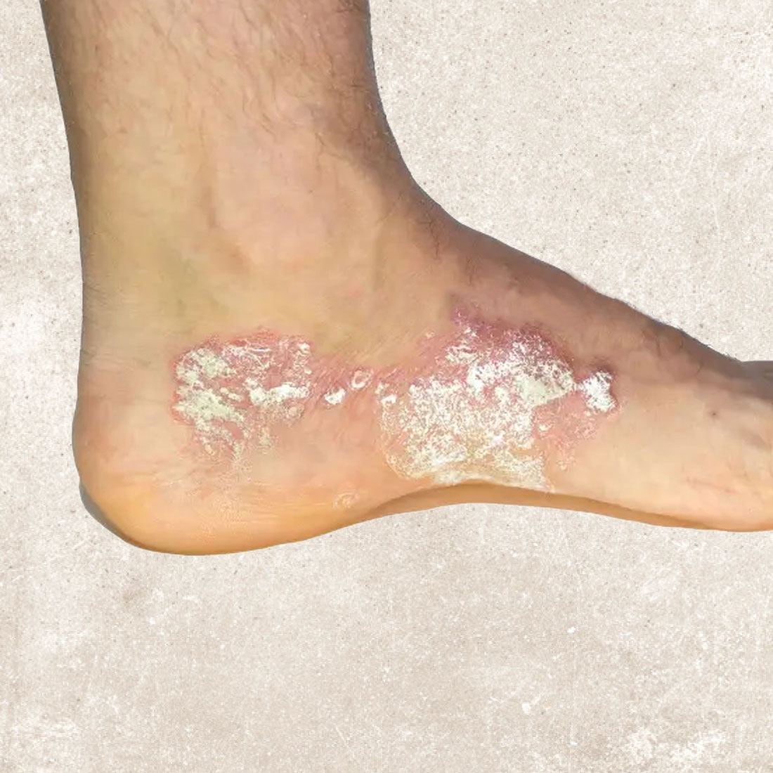 psoriash